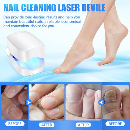 Rechargeable Nail Fungus Laser Device – Anti-Fungal Treatment for Hands & Feet (1 Pc)
